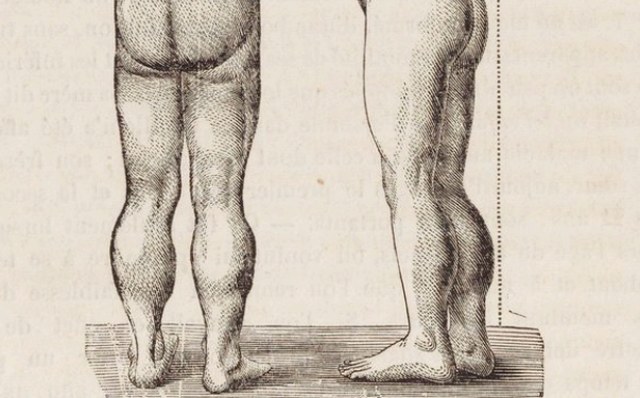 Nineteenth-century engraving showing calf pseudohypertrophy in a child with Duchenne muscular dystrophy.