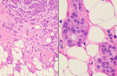 Dos vistas de histopatología teñida de un carcinoma ductal invasivo de mama, el tipo de preparación del que se tomaron las medidas de los núcleos tumorales.